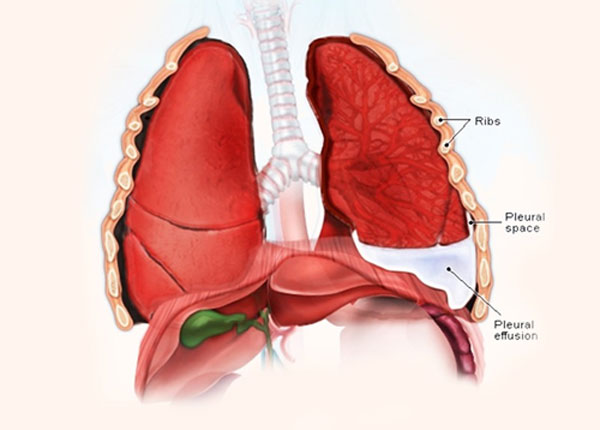 Tràn dịch màng phổi là biến chứng sốt xuất huyết thường gặp ở bệnh nhi